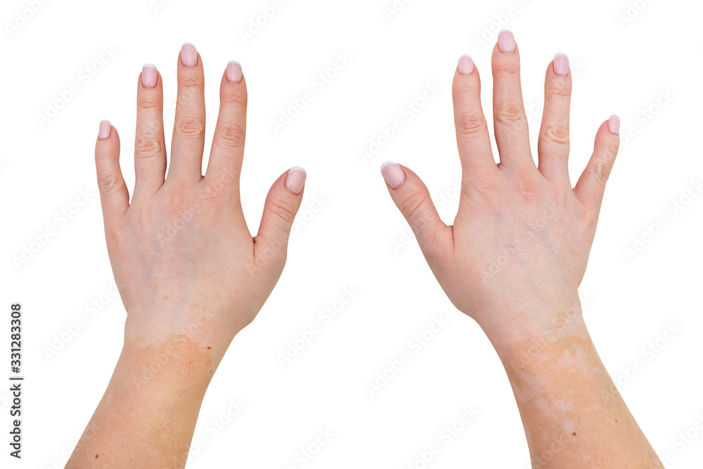 Stains from vitiligo disease on the outer parts of the hand of a young Caucasian woman, isolated on a white background with a clipping path. Stains from vitiligo disease on the outer parts of the hand of a young Caucasian woman, isolated on a white background with a clipping path.