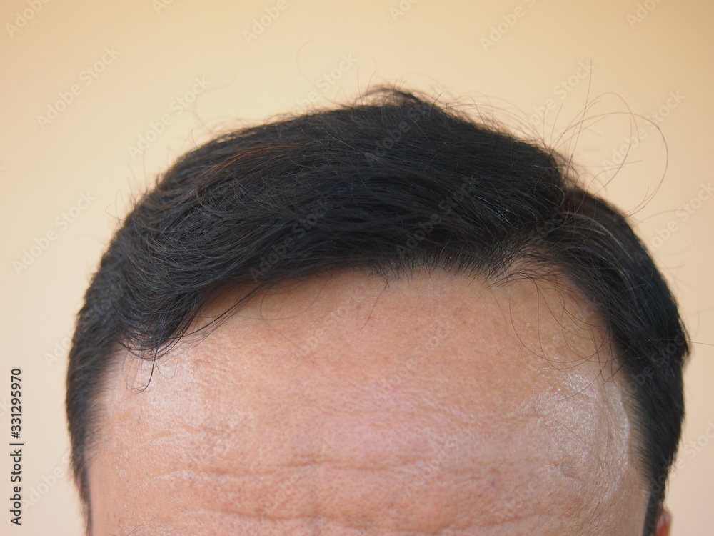 men closeup hair loss problem on orange background for health care medical and shampoo product concept. men closeup hair loss problem on orange background for health care medical and shampoo product concept.