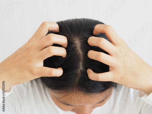 woman scratching her head cause of have a lice or louse and dandruff and scurf problem of scalp and hair treatment of peeling from allergy or lichen using for shampoo product concept.