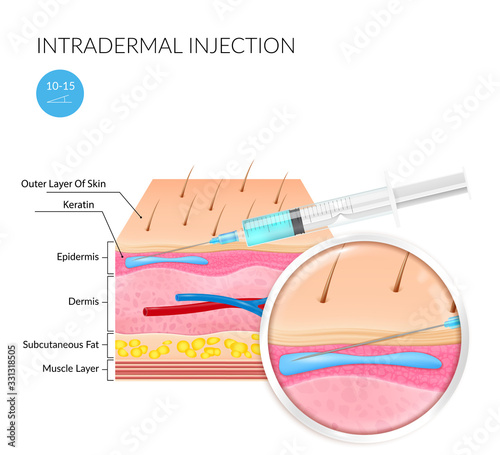 Realistic image of Intradermal injection on a white background with the image of the structure of the skin and subcutaneous layers. Vector illustration on a medical theme photo