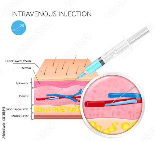 Realistic image of Intravenous injection on a white background with the image of the structure of the skin and subcutaneous layers. Vector illustration on a medical theme