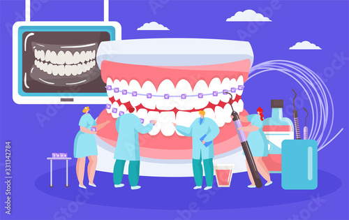Installing dental braces vector illustration with dentists mini people with huge mouth orthodontic cocept. White spots braces on teeth, stomatology, dentistry, orthodontry healthcare.