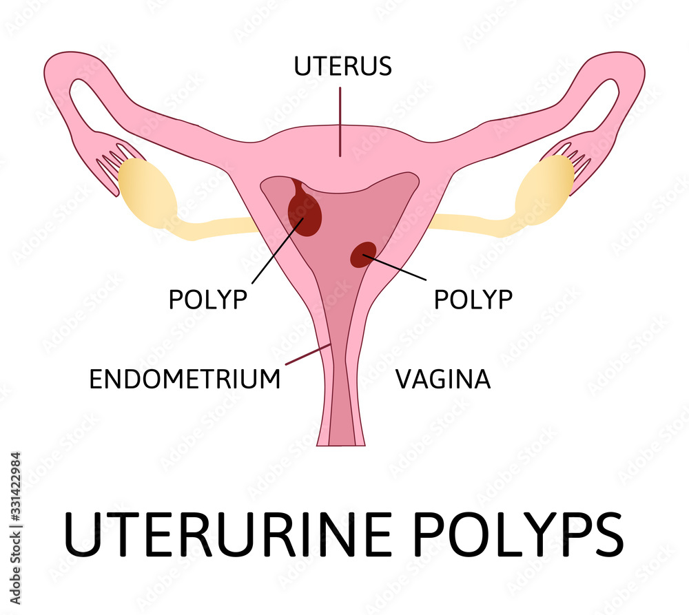 Uterine polyps. Human realistic uterus. Anatomy illustration. Stock