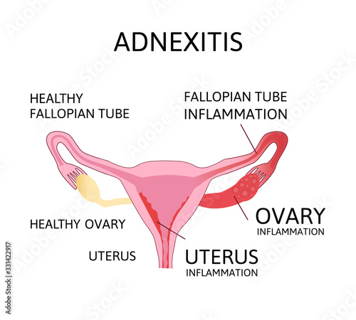 Uterus and ovaries scheme, adnexitis - infection and inflammation in the fallopian tube and ovary. Uterus inflammation. photo