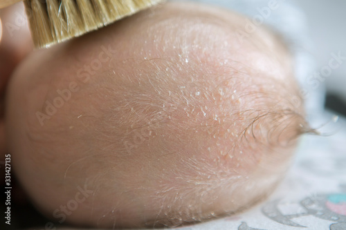 Cradle cap on a newborn child head. Parent brushing head of a child because of a cradle cap. 