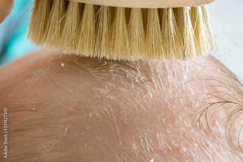 Cradle cap on a newborn child head. Parent brushing head of a child because of a cradle cap. 