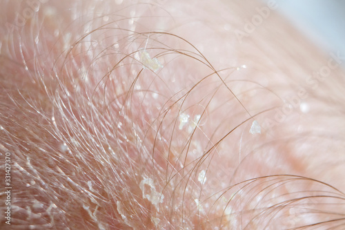 Cradle cap on a newborn child head. Parent brushing head of a child because of a cradle cap. 