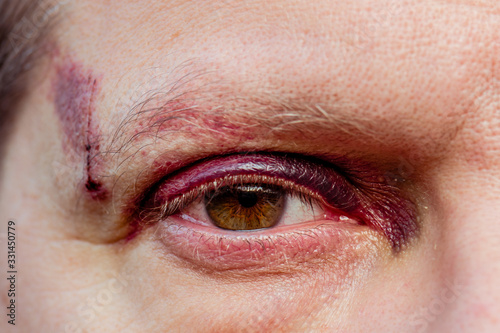 A white man with a purple black eye and head injury - eye open