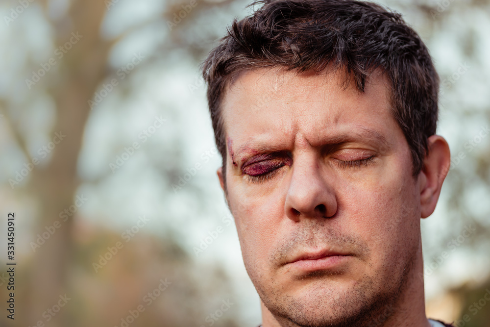 A white man with stubble with a purple black eye and head injury - eyes closed - outside A white man with stubble with a purple black eye and head injury - eyes closed - outside