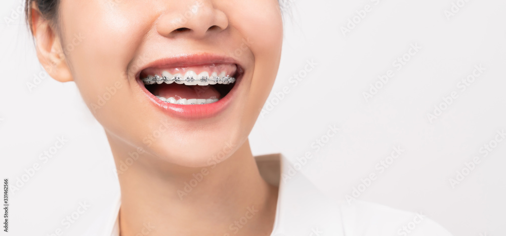 Face of a young smiling asian woman with braces on teeth, Orthodontic Treatment. Face of a young smiling asian woman with braces on teeth, Orthodontic Treatment.