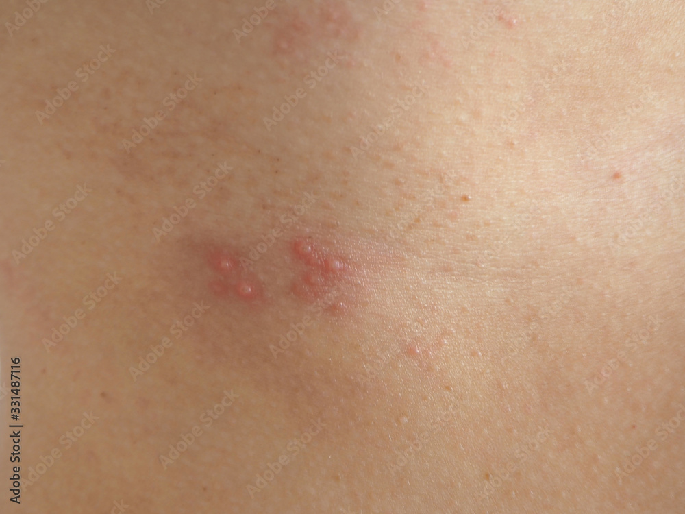 herpes zoster or shingles in woman on her skin, cause of varicella zoster virus infections symptoms of itchy ,rash and raised dots and redness with pain and tingling  suffering