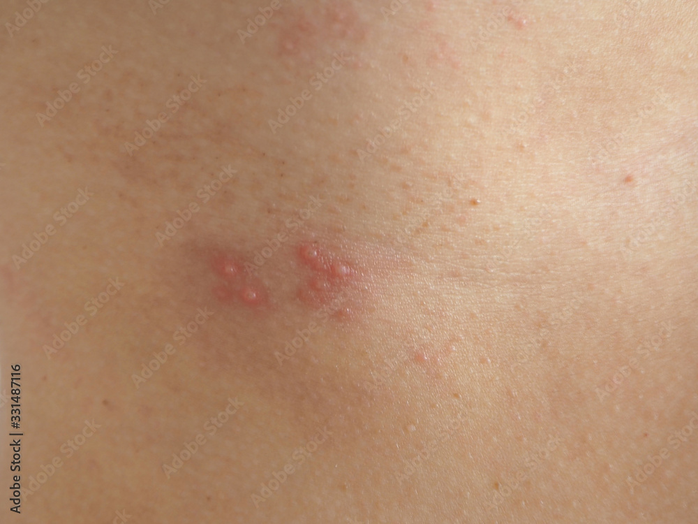 herpes zoster or shingles in woman on her skin, cause of varicella zoster virus infections symptoms of itchy ,rash and raised dots and redness with pain and tingling suffering herpes zoster or shingles in woman on her skin, cause of varicella zoster virus infections symptoms of itchy ,rash and raised dots and redness with pain and tingling suffering