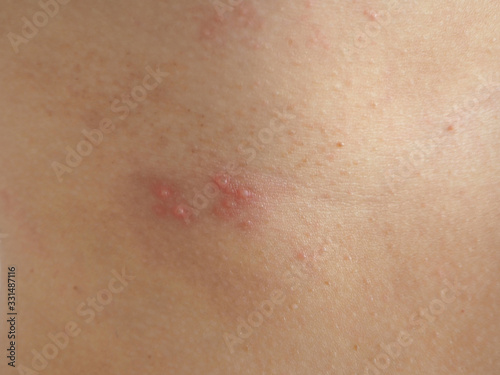 herpes zoster or shingles in woman on her skin, cause of varicella zoster virus infections symptoms of itchy ,rash and raised dots and redness with pain and tingling  suffering photo