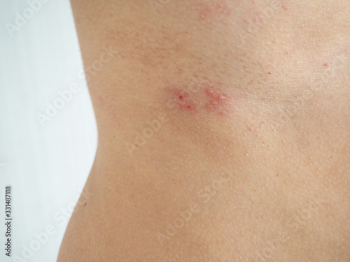 herpes zoster or shingles in woman on her waist , cause of varicella zoster virus infections symptoms of itchy ,rash and raised dots on skin and redness with pain and tingling  suffering. photo