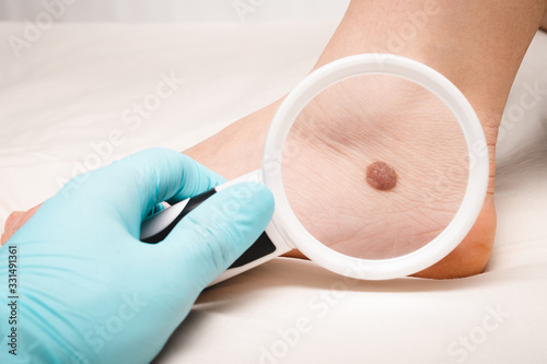 Doctor's examination of a mole on a person's leg. The concept of preventing the development of melanoma.
