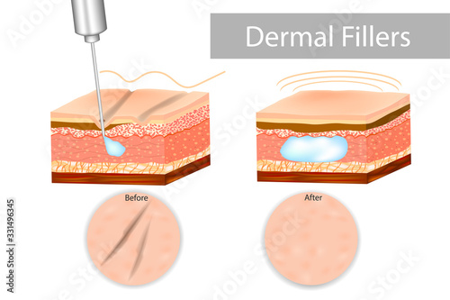 Dermal fillers, also known as "injectables" or "soft-tissue fillers"