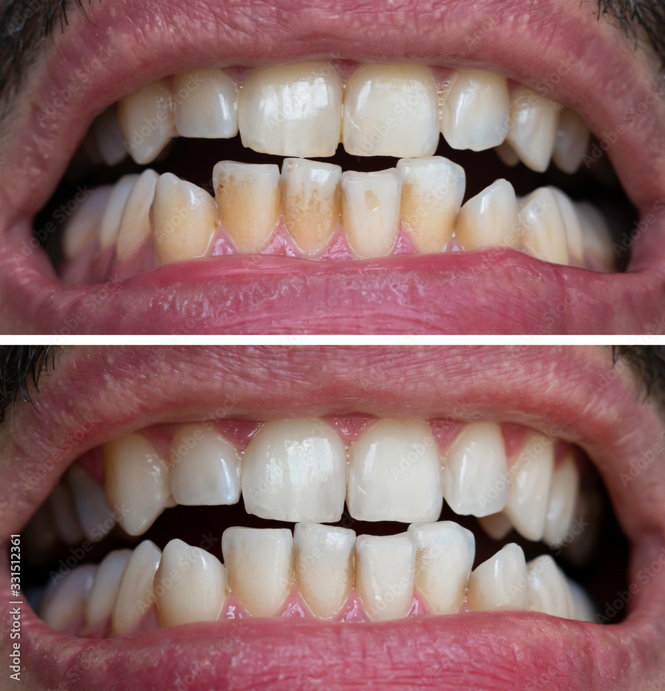 Natural Teeth Bleaching, Teeth Before And After Whitening, Dental Care
