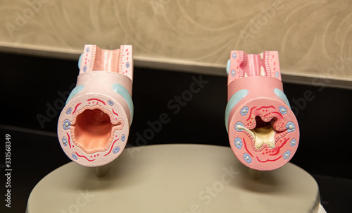 healthy lung tissue and inflamed lung tissue models