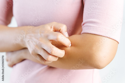 Closeup of young woman scratching the itch on her arm. Health care and medical concept.