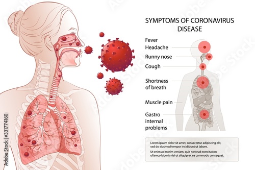 Human MERS-Cov symptoms risk factors. Virus outbreak spread pandemic.
