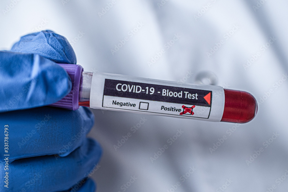 Obraz premium blood sample ampoule coronavirus, covid-19, positive test result