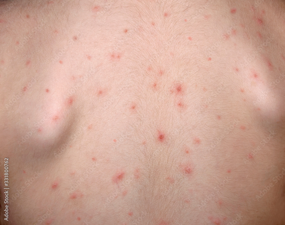 Chickenpox disease. Boy sick on his back . Chickenpox virus, chicken pox outbreak in children. Concept of contagion. Chickenpox disease. Boy sick on his back . Chickenpox virus, chicken pox outbreak in children. Concept of contagion.