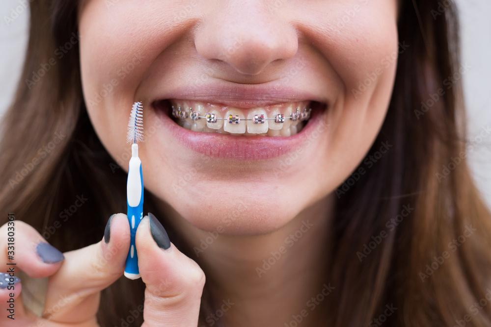 Beautiful young girl with metal braces for teeth with white teeth and brush Beautiful young girl with metal braces for teeth with white teeth and brush