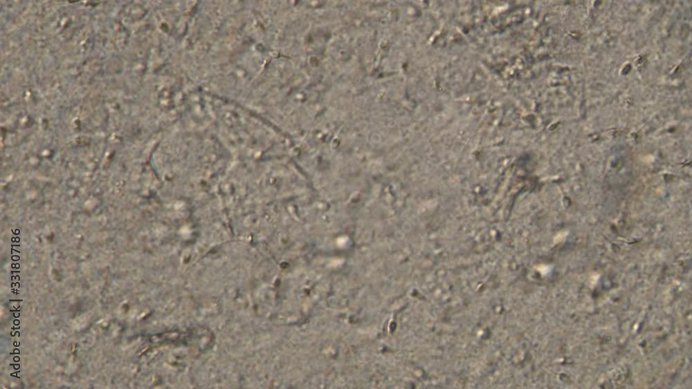 Microscopy of human sperm . Magnification 150x moving of spermatozoides in detail under microscope. Microscopy of human sperm . Magnification 150x moving of spermatozoides in detail under microscope.