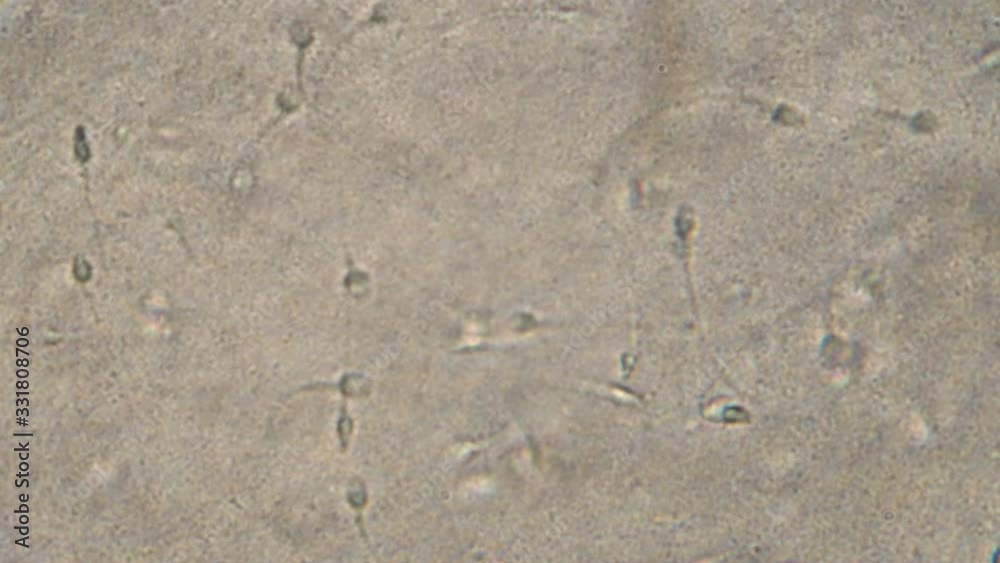 Microscopy of human sperm . Magnification 300x moving of spermatozoides in detail under microscope. Microscopy of human sperm . Magnification 300x moving of spermatozoides in detail under microscope.