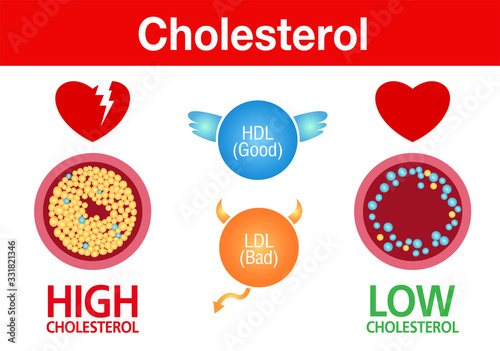 Cholesterol in artery, health risk ,exercise, vector design
