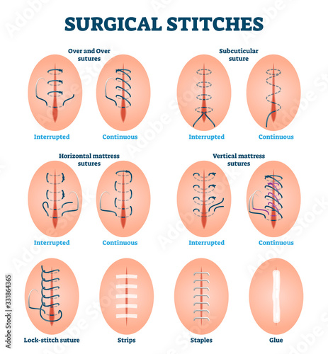 Surgical stitches vector illustration. Labeled various cut injury treatment