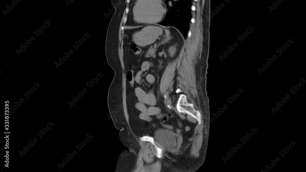 Purified MRI of the abdomen, gastrointestinal tract, bladder Purified MRI of the abdomen, gastrointestinal tract, bladder