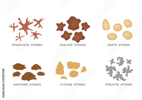 types of kidney stone vector