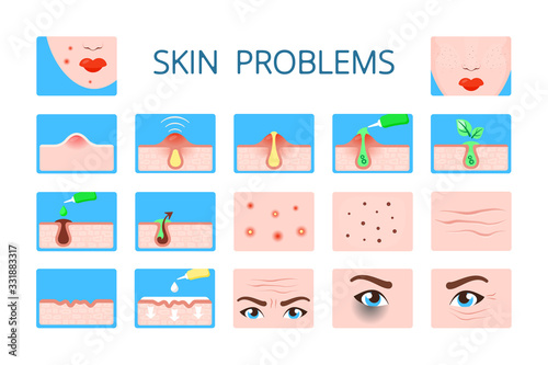 skin problem. hygiene infographic damaged skin dark circles face infection ages wrinkles clogged pores zits vector