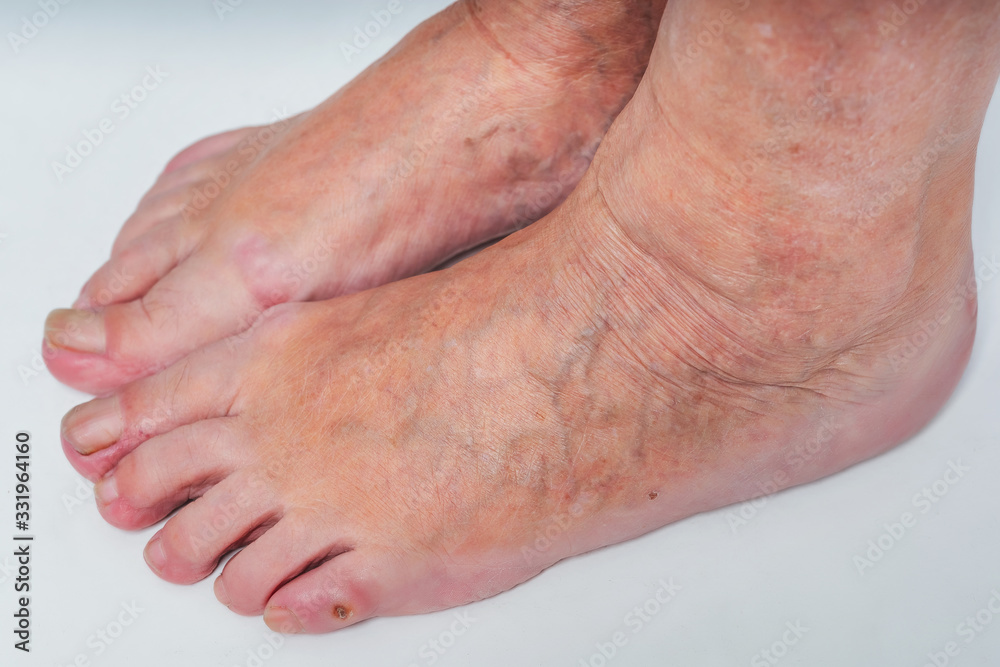 Varicose veins on the feet of an elderly woman. Inflamed dilated veins
