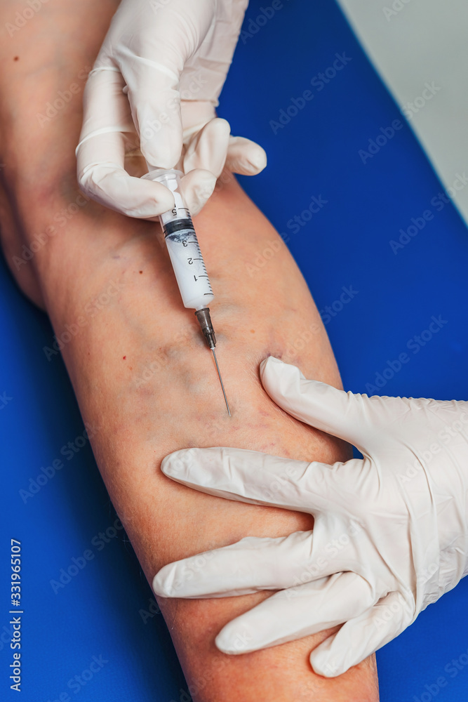 Injections into the veins of an elderly woman's leg closeup. Doctor's injections in the veins
