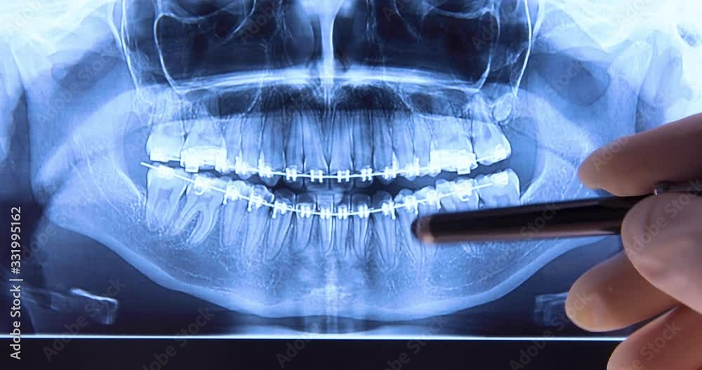 Stomatologist analyzing dental xray with braces. Radiography for teeth