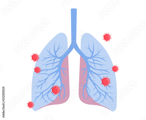 Concept Of Healthcare And Medicine, Epidemic Of Coronavirus 2019-Ncov. Infographic Of Infected Lungs. Virus Diagnosis And Treatment. Necessity Of Vaccination. Cartoon Flat Style. Vector Illustration