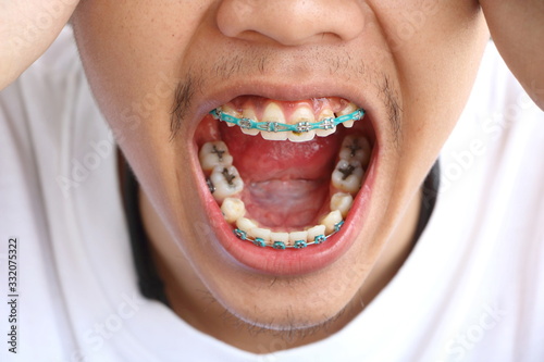Canvas Print Close up Asian man teeth was braces have food scraps attached, concept unclean b