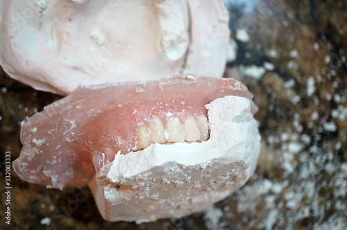 Denture Making Process of Removing From the Mold