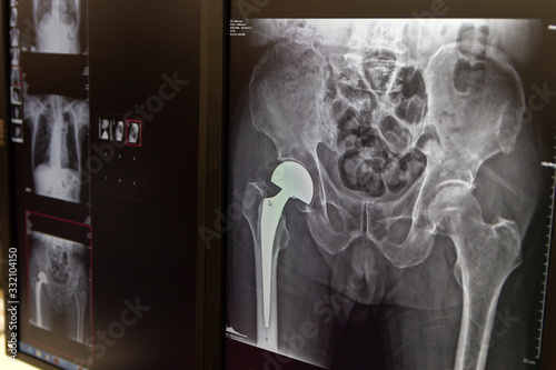 X-ray of the hip prosthesis elderly man photo