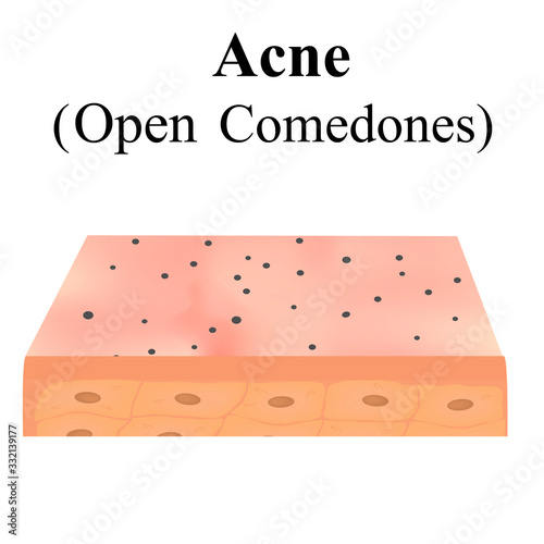 Open comedones. Acne on the skin. Dermatological and cosmetic diseases on the skin of the face acne. Infographics. Vector illustration on isolated background.