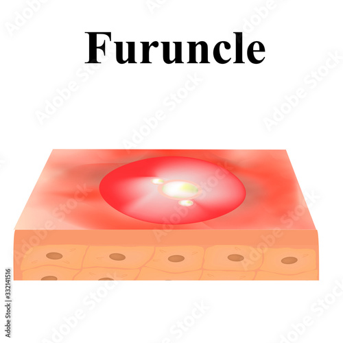 Cyst acne. furuncle Acne on the skin cysts and pimples. Dermatological and cosmetic inflammatory diseases on the skin of the face. Infographics. Vector illustration on isolated background.
