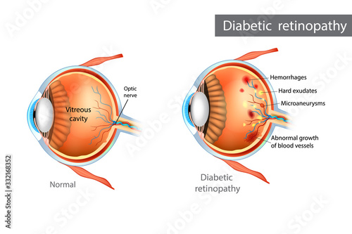 Diabetic retinopathy. Difference between Normal Retina and Diabetic Retinopathy photo