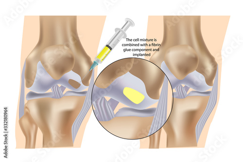 Stem cell therapy ( Injections) for repair of knee cartilage.The cell mixture is combined with a fibrin glue component and implanted.