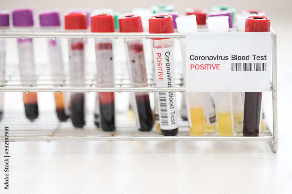 Blood test tube  for laboratory analysis.Laboratory testing patient’s blood samples.Conceptual image coronavirus (COVID-19) test tube sample that has tested positive for coronavirus.