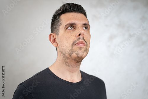 Alopecia areata on a man's beard