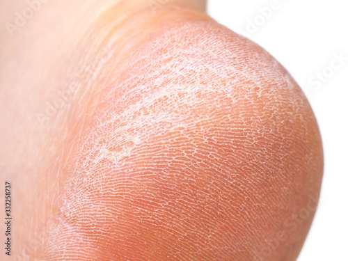 female heel with dry, cracked, damaged skin of the foot close-up isolated on a white background