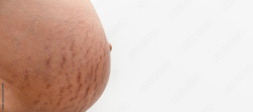 Stretch marks on a pregnant belly, panoramic mock-up with space for text Stretch marks on a pregnant belly, panoramic mock-up with space for text