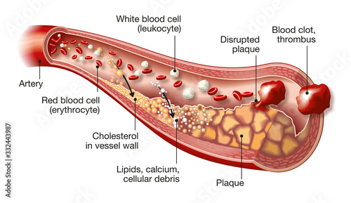 Quadro em tela Arteriosclerosis, thrombosis, 3D medical illustration